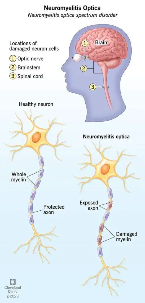 9858 neuromyelitis optica