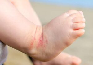 baby feet with Eczema 596089610 770x533 1 jpg