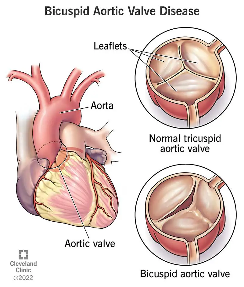 bicuspid aortic valve disease