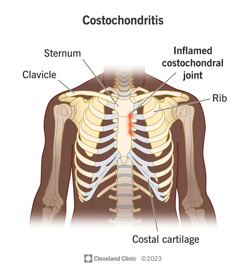 costochondritis