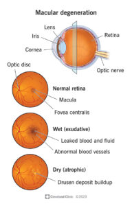 macular degeneration 2