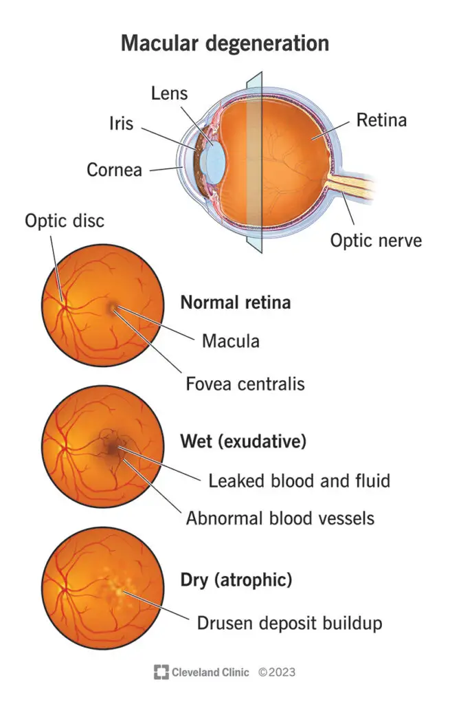 macular degeneration 2