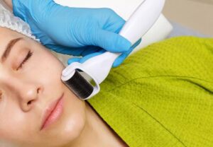 microneedling 699873274 770x533 1 jpg