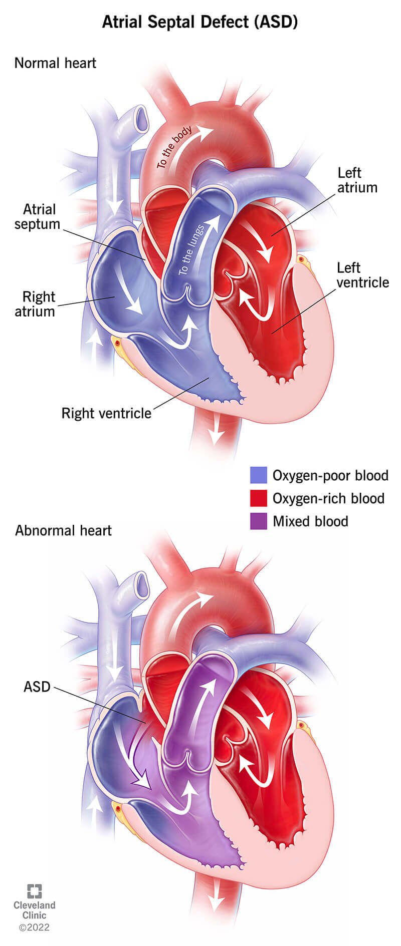 11622 atrial septal defect