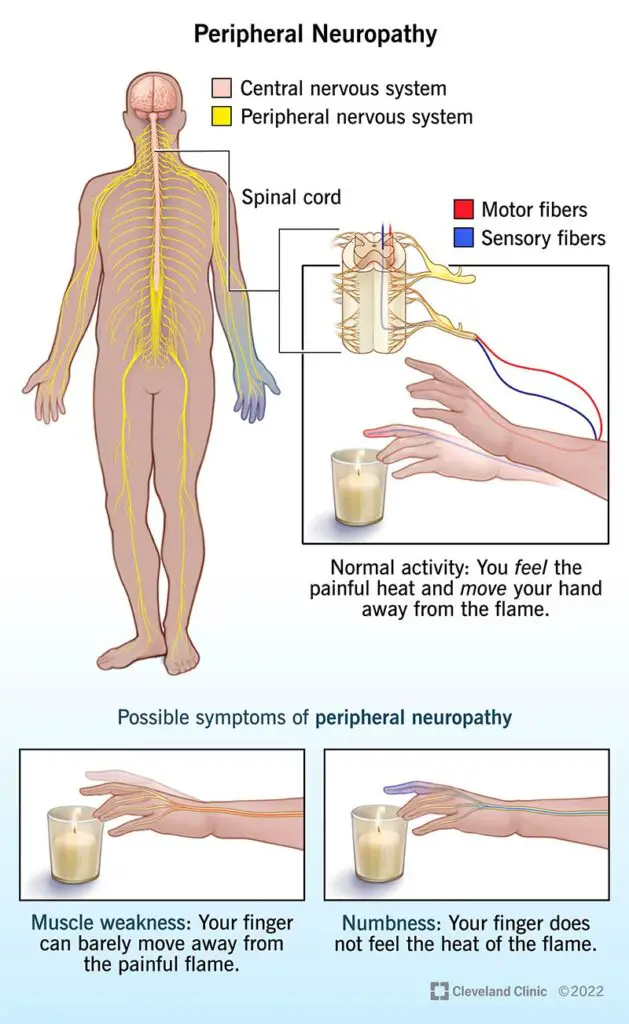 14737 peripheral neuropathy