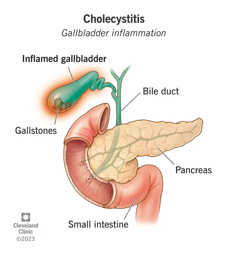 Cholecistitas yra tulžies pūslės, tulžies kaupimo organo, uždegimas.