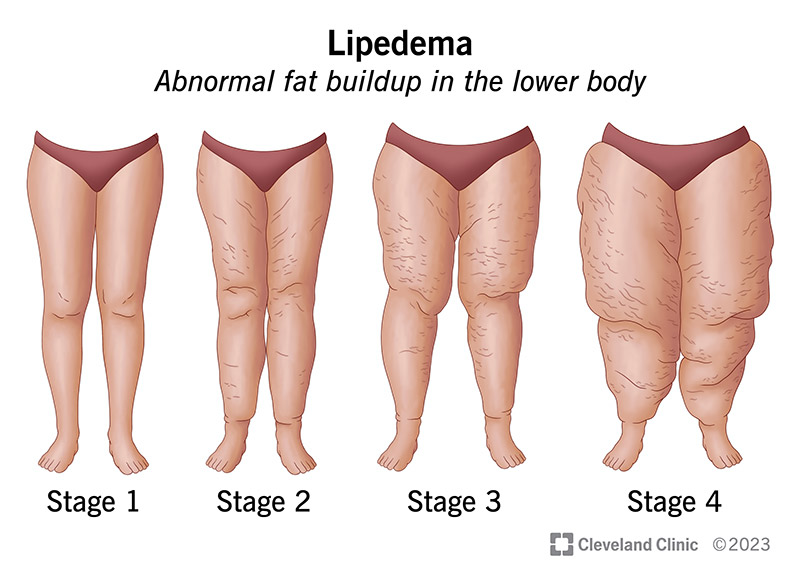 Lipedema sukelia nenormalų riebalų kaupimąsi apatinėje kūno dalyje, kuri laikui bėgant blogėja.