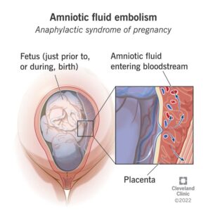 1725210024 15463 amniotic fluid embolism