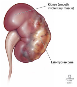 1725264619 22059 leiomyosarcoma illustration