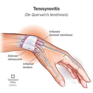 1725457226 23448 tenosynovitis