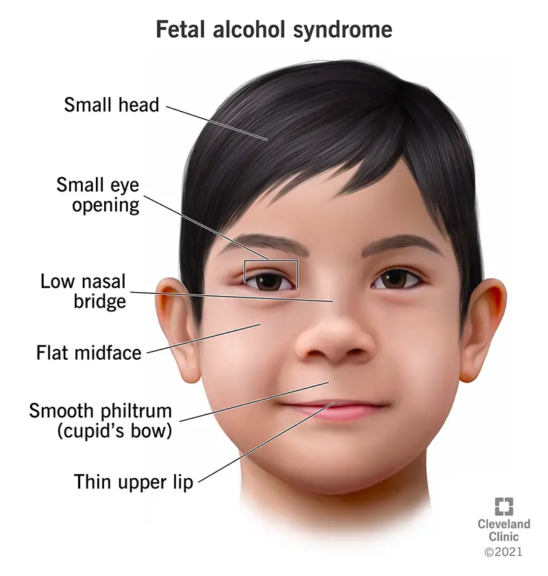 1725481817 15677 fetal alcohol syndrome