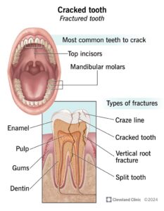 1725490524 cracked tooth types