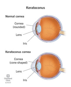 1725520834 keratoconus