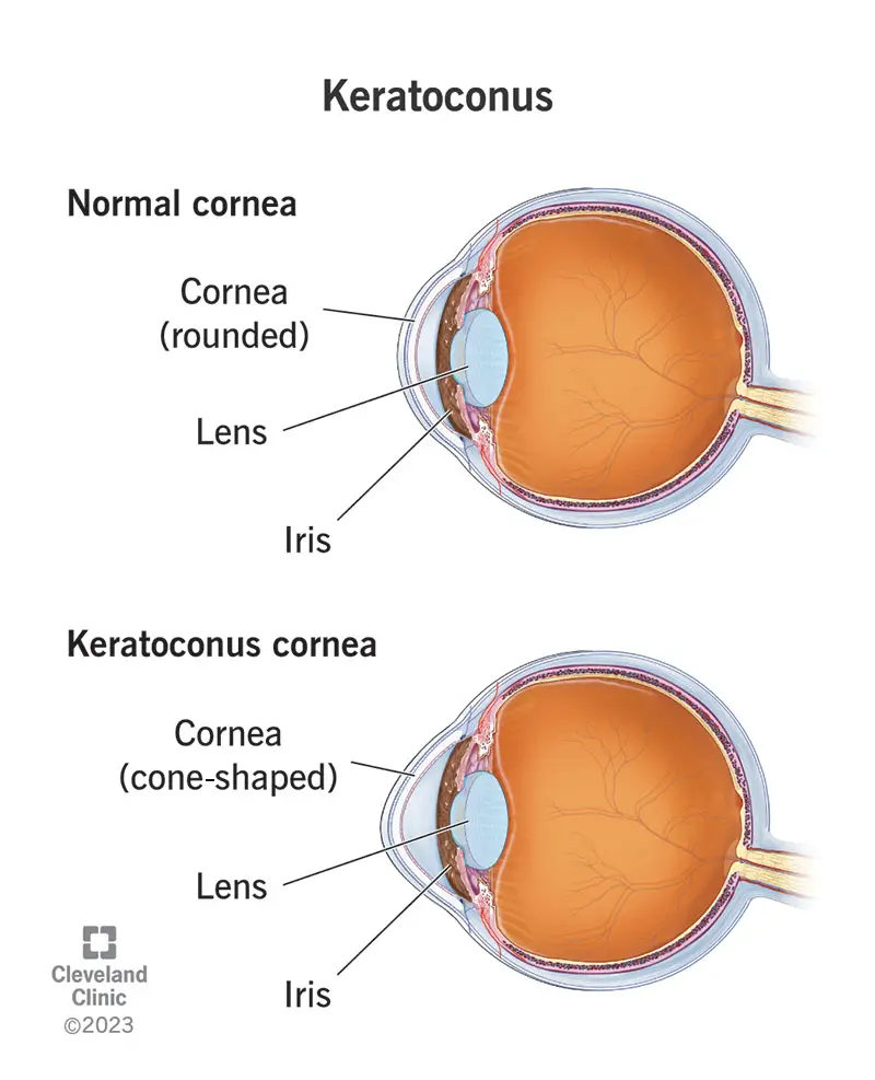 1725520834 keratoconus