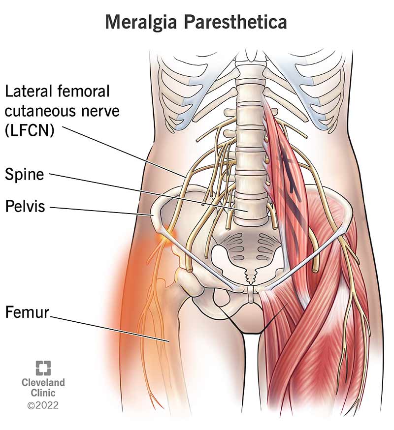 1725558317 17959 meralgia paresthetica