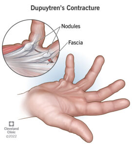 1725595816 16941 dupuytrens contracture