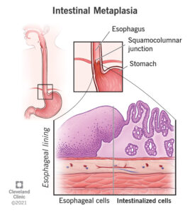 1725620417 22215 intestinal metaplasia