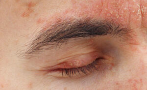 1725651016 25025 psoriasis on eyelids