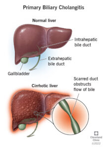 1725710114 17715 primary biliary cholangitis