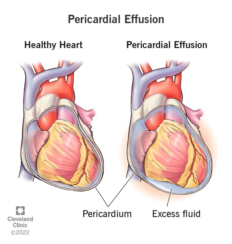 1725763817 17351 pericardial effusion