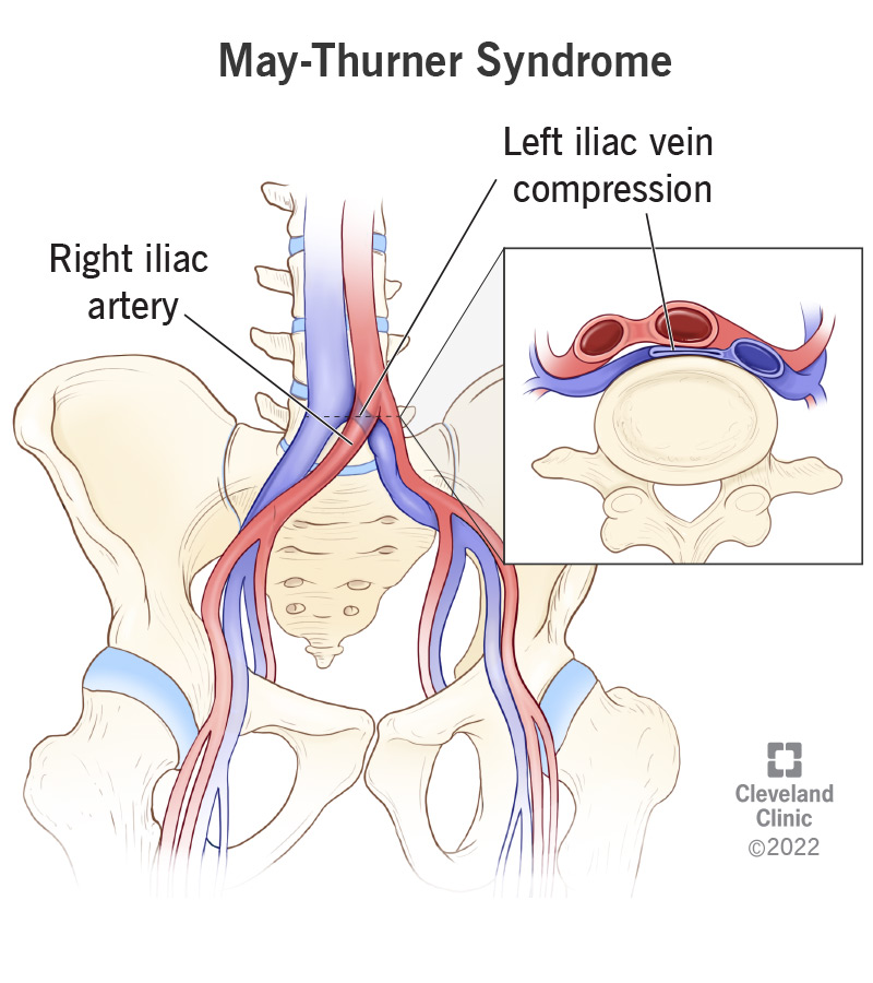 1725774915 17213 may thurner syndrome