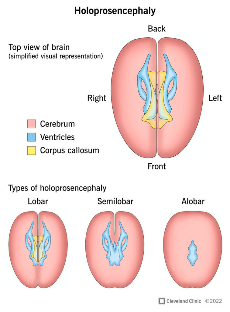 1725783316 22919 holoproscenephaly