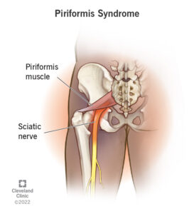 1725877214 23495 piriformis syndrome