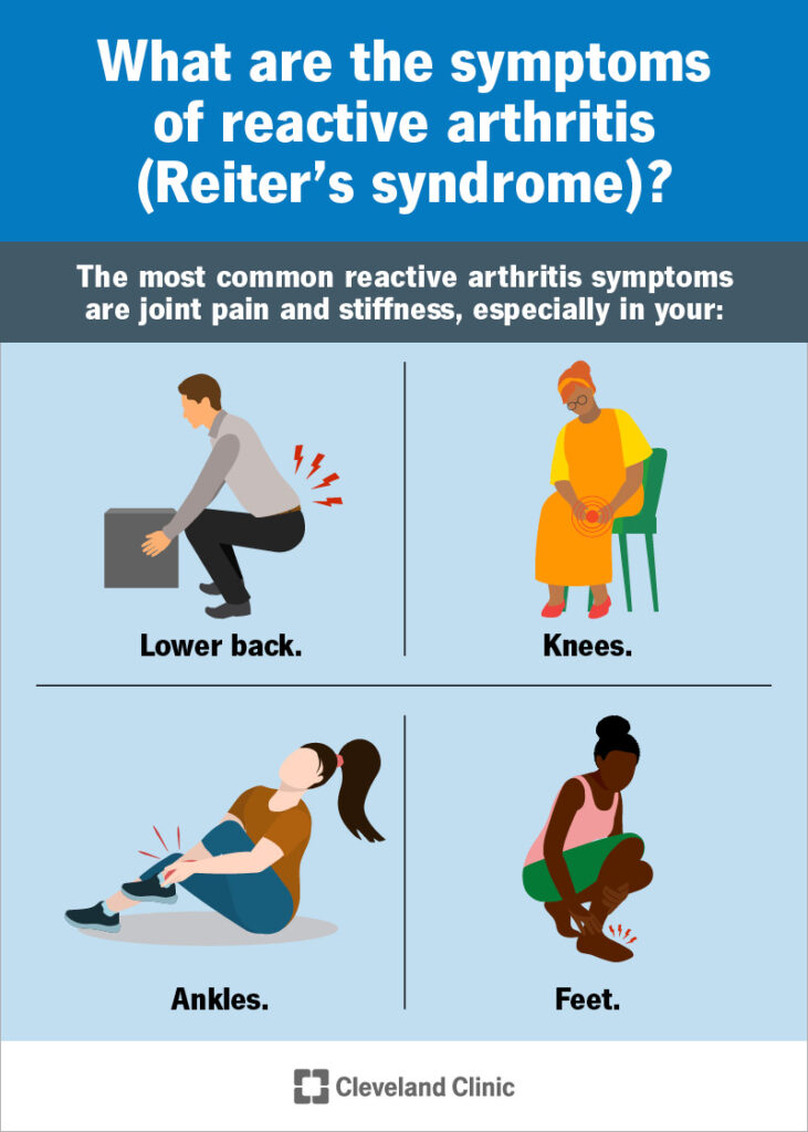 1725922517 reactive arthritis reiters syndrome