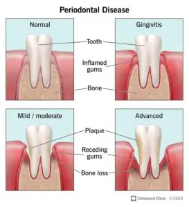 1725955216 21482 periodontal disease