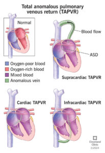 1725971113 23069 total anomalous pulmonary venous return illustration