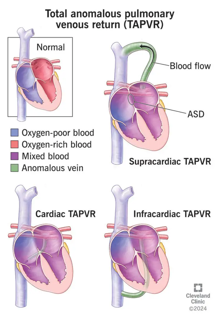 1725971113 23069 total anomalous pulmonary venous return illustration