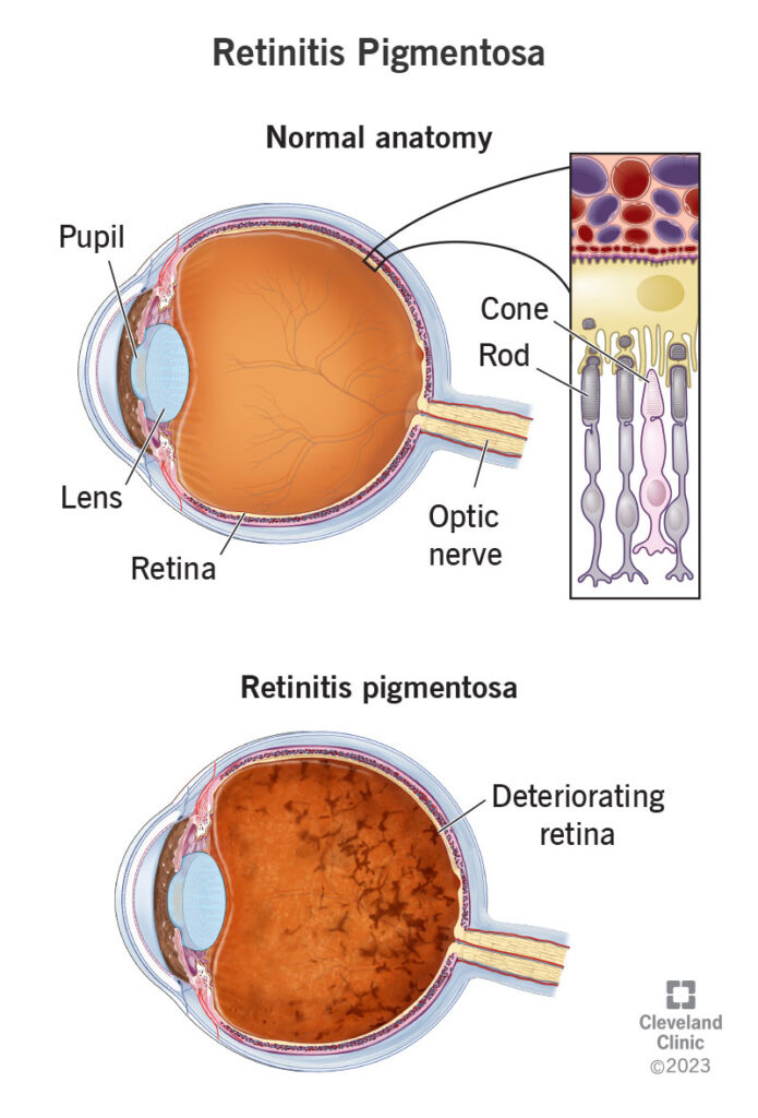 1725999315 17429 retinitis pigmentosa