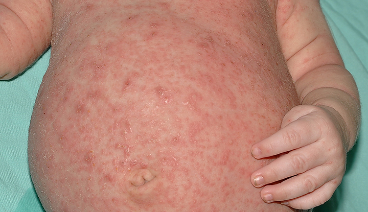 1726014314 4567 scabies