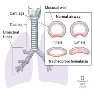 1726040416 22061 tracheobronchomalacia illustration