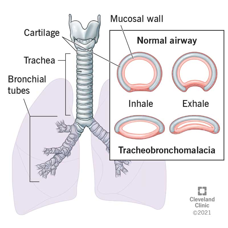 1726040416 22061 tracheobronchomalacia illustration