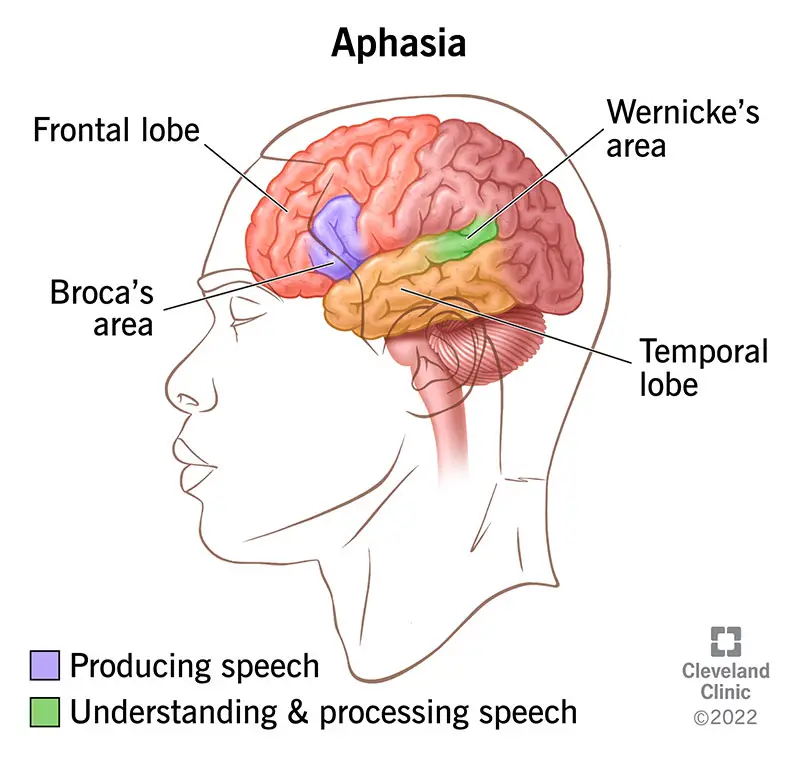 1726065318 5502 aphasia