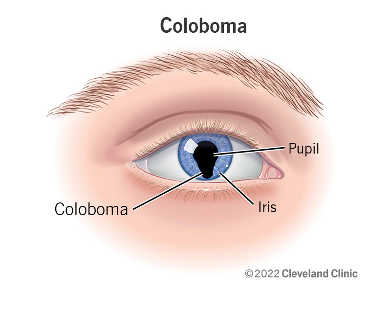 1726191615 22682 coloboma