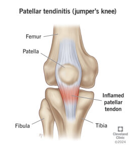 1726300515 patellar tendinitis jumpers knee