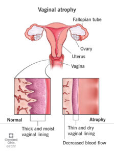 1726330818 15500 vaginal atrophy