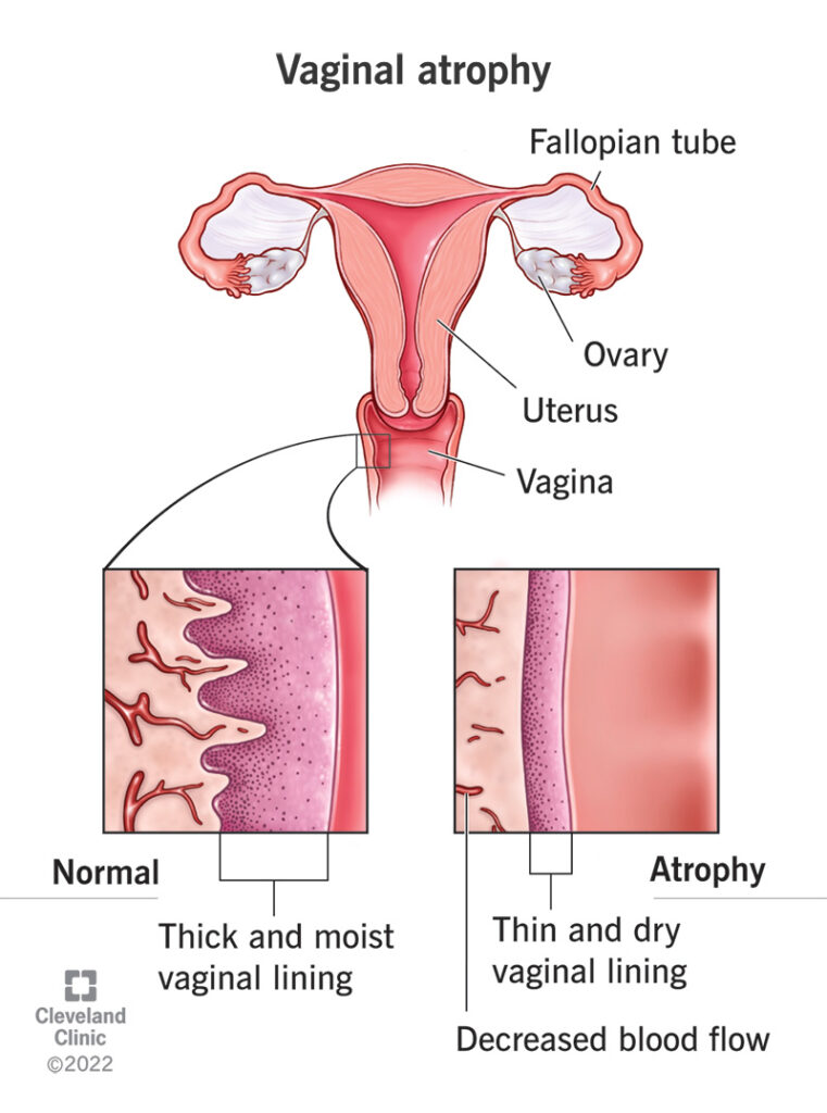 1726330818 15500 vaginal atrophy