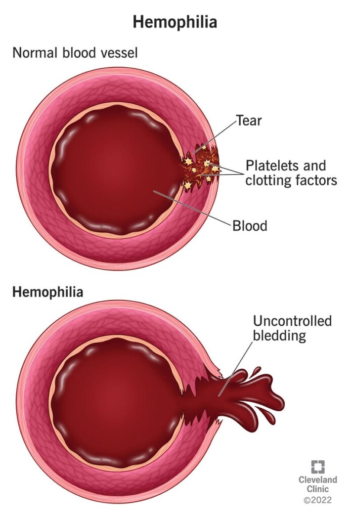 1726346415 14083 hemophilia