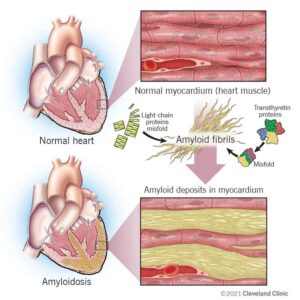 1726364417 22598 cardiac amyloidosis