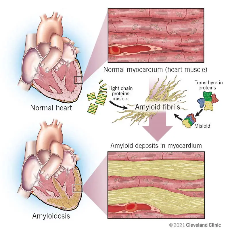 1726364417 22598 cardiac amyloidosis