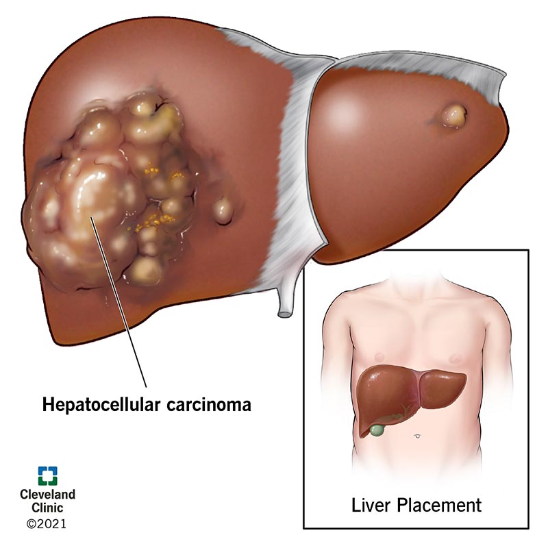 1726419021 21709 Hepatocellular Carcinoma Illustration