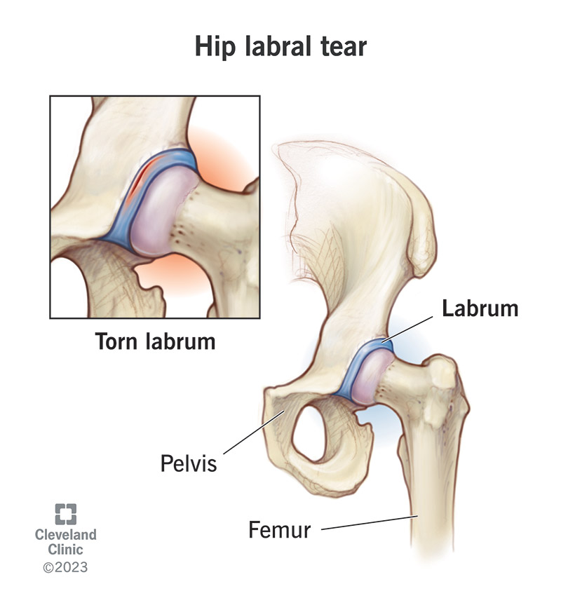 1726424122 hip labral tear