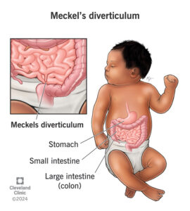 1726435516 14738 meckels diverticulum