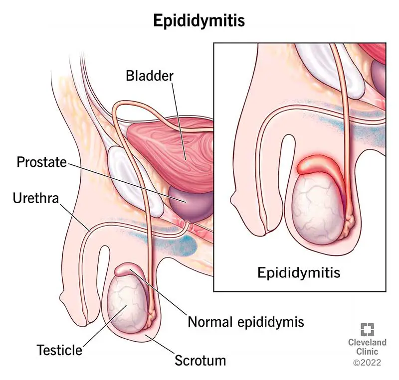 1726548613 17697 epididymitis