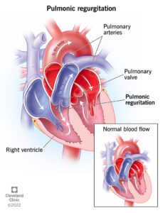 1726558008 23280 pulmonic regurgitation