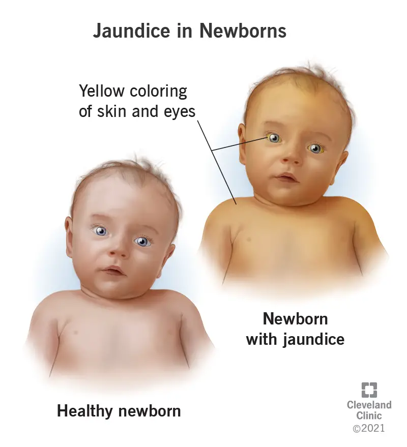 1726661423 22263 jaudince in newborns