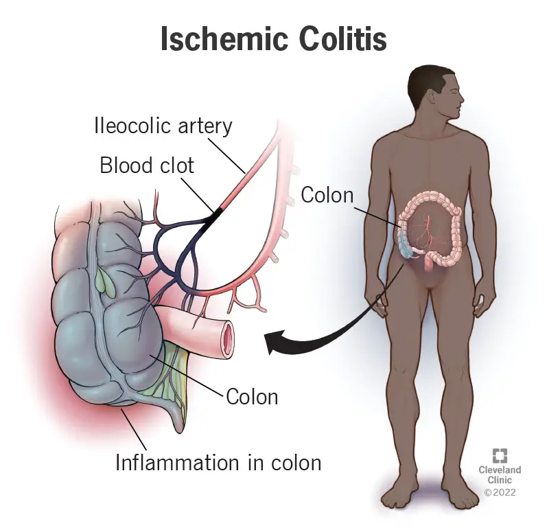 1726716418 24513 ischemic colitis